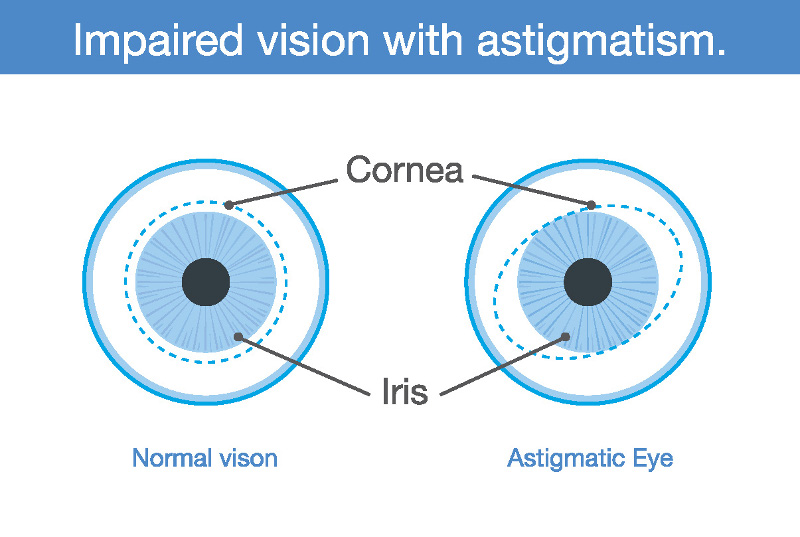 When the cornea or lens of an eye is irregularly shaped, vision may be out of focus at any distance. ©2009 Eyemaginations, Inc. Possible view through an astigmatic eye -- Image courtesy of Eyemaginations™