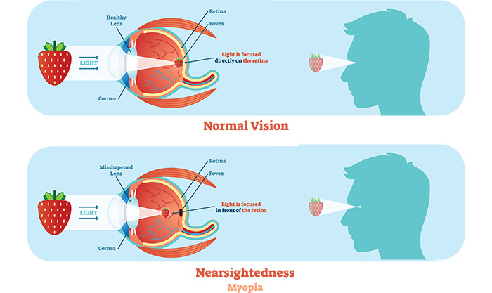 gyógyszerek a látáshoz a-vitaminnal az abszolút látás kialakulása
