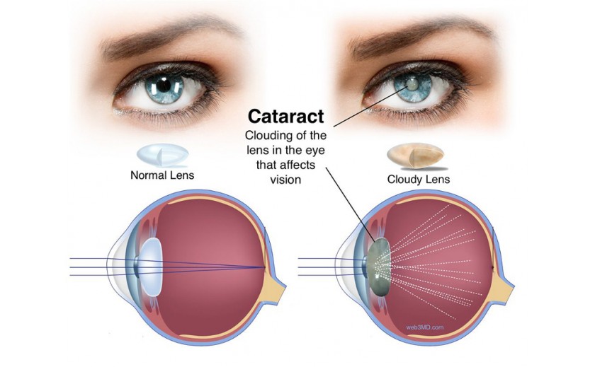 Cataract